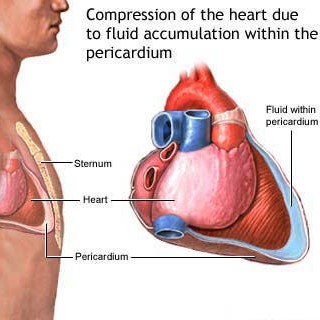 pericardium-Surgery